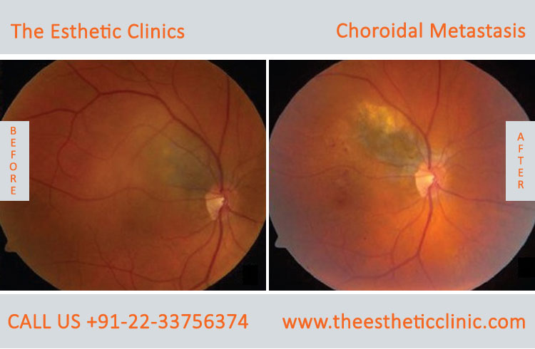 Choroidal Metastasis Eye Cancer Treatment before after photos in mumbai india (2)